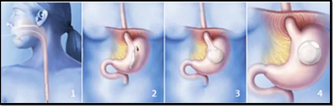 Ballon gastrique en tunisie