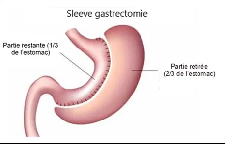 Sleeve gastrique Tunisie