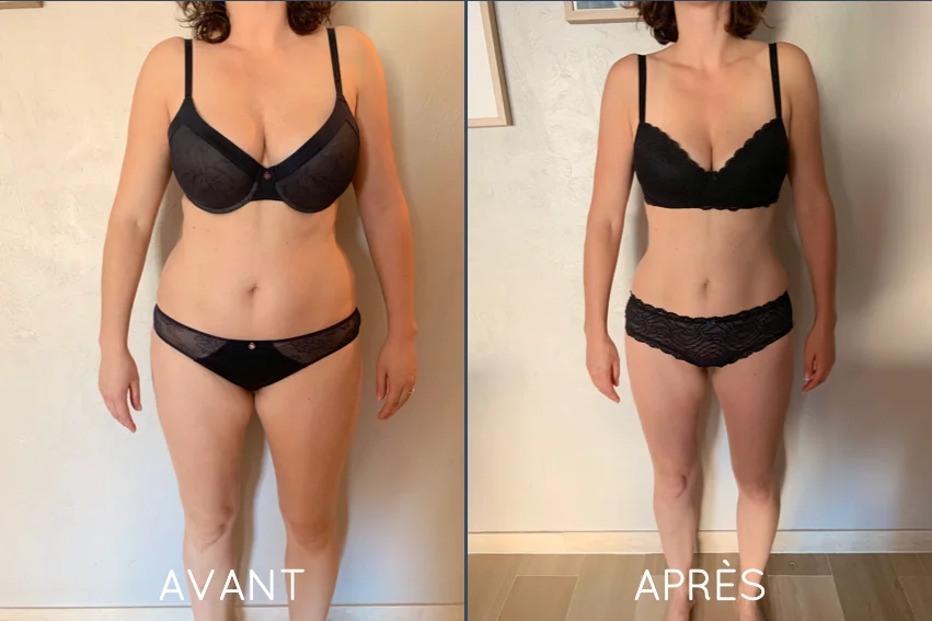 avant apres Sleeve gastrique Tunisie