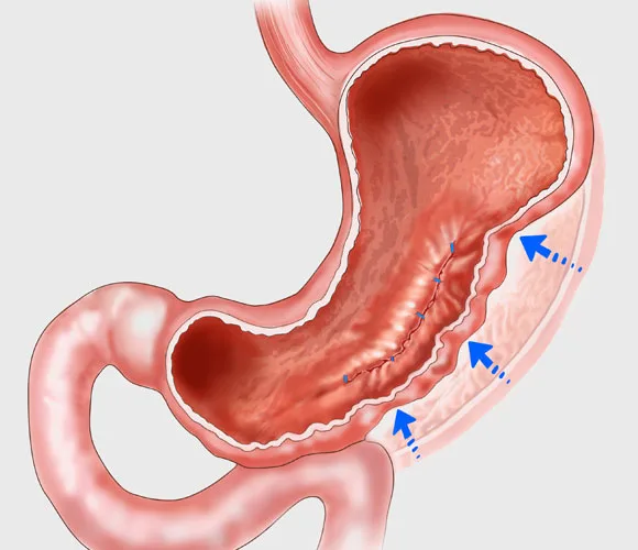 sleeve gastroplastie