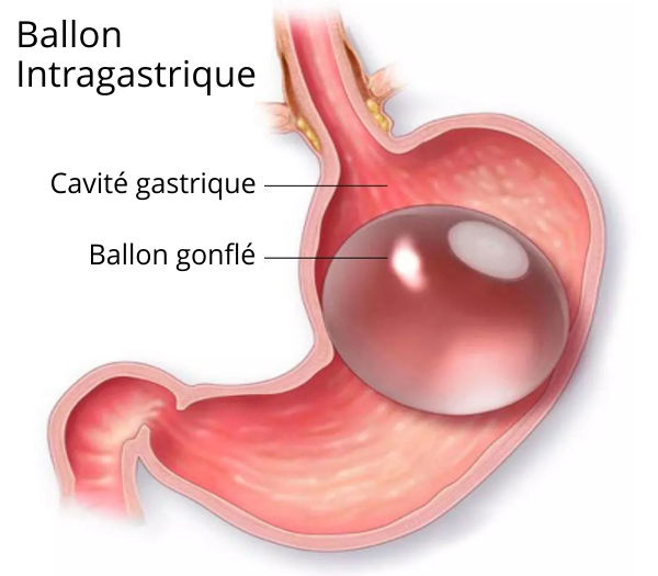 ballon gastrique 
