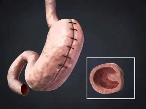 plicature gastrique en Tunisie