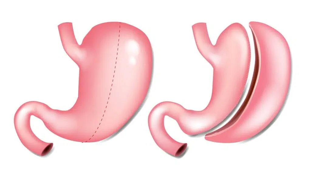 plicature gastrique en Tunisie